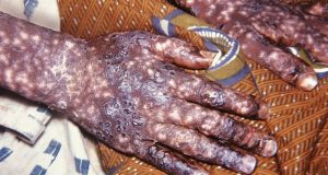 Variole du singe au Sénégal : 25 cas contacts sous surveillance médicale