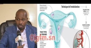 Abdoulaye Diop: « Je vais vous révéler l’un des facteurs favorisant le fibrome »