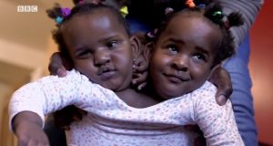 Ndèye et Marième, des jumelles siamoises qui luttent pour leur vie