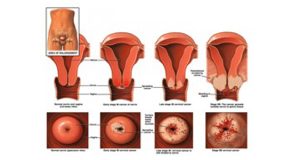 Sédhiou : 12 cas de cancer du col de l’utérus suspectés chez des filles de 9 ans