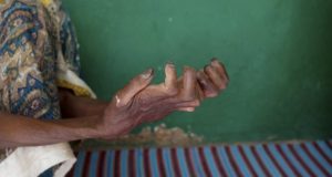 Sénégal : près de 200 nouveaux cas de lèpre recensés au Sénégal en 2020