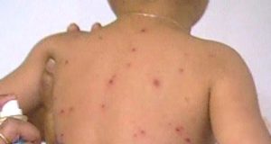 UNE ÉPIDÉMIE DE ROUGEOLE À VÉLINGARA : 26 CAS ENREGISTRÉS