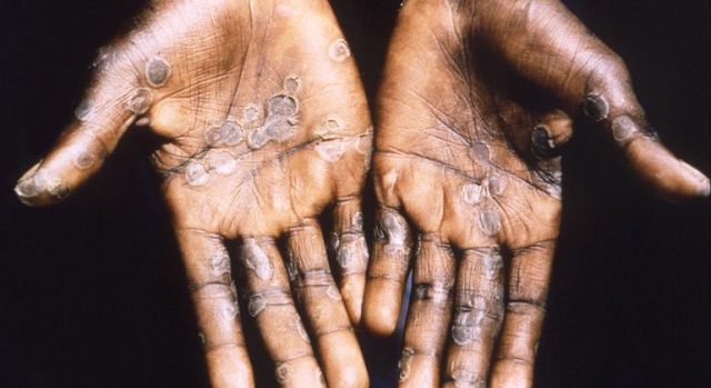 variole-du-singe-plus-de-1-400-cas-detectes-dans-7-pays-africains-selon-loms