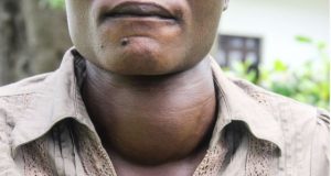 Prise en charge des maladies de la thyroïde : les malades demandent plus à l’Etat