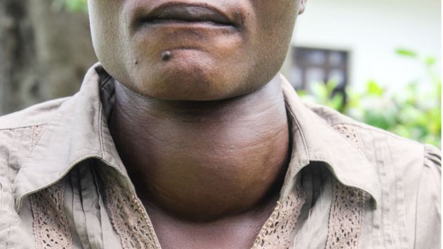 thyroide-et-cartilage-.jpg