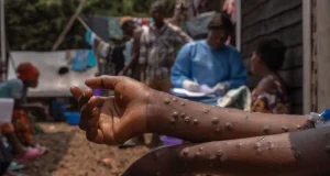 Santé : Un deuxième cas de MPOX confirmé par le Ministère de la santé