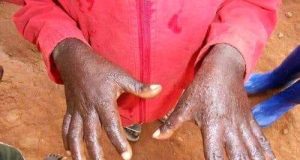 Kédougou : des démangeaisons inexpliquées paralysent une école